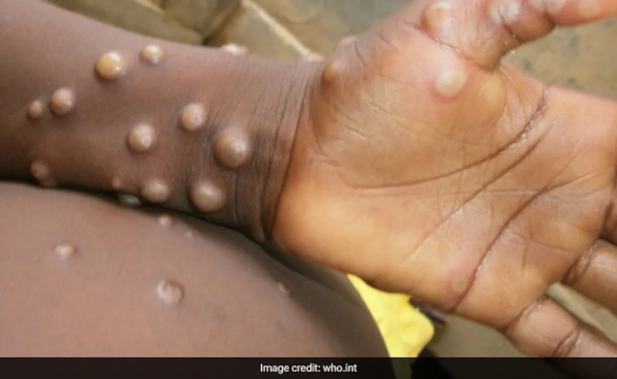 person suffering from monkeypox